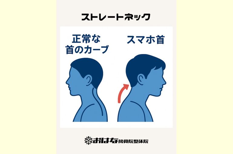 ストレートネック